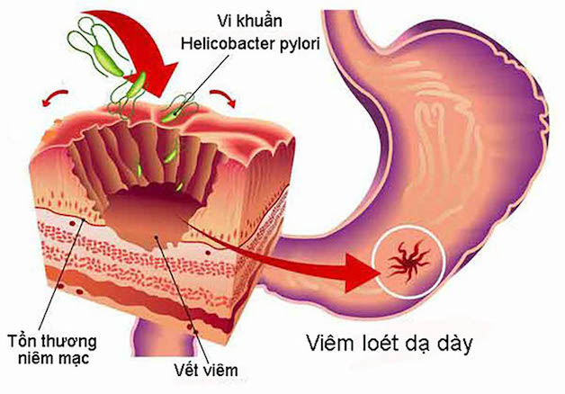 làm gì khi xét nghiệm H.pylori dương tính