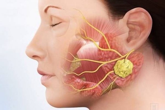 Người bệnh mắc sỏi tuyến nước bọt và các loại ung bướu cũng có thể bị khô miệng.