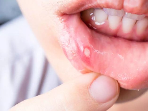 thuốc bôi nhiệt miệng cho bé loại nào tốt