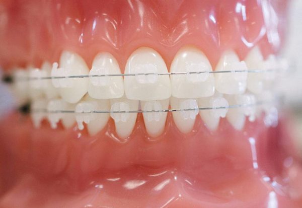 Mắc cài sứ có màu sắc tự nhiên, giống răng thật và ít lộ hơn khi giao tiếp.