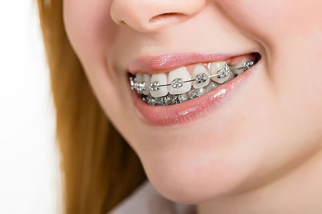 Niềng răng mắc cài được xem là phương pháp hoàn hảo nhất cho nắn chỉnh răng hô vì nó điều trị tất cả những trường hợp phức tạo nhất.