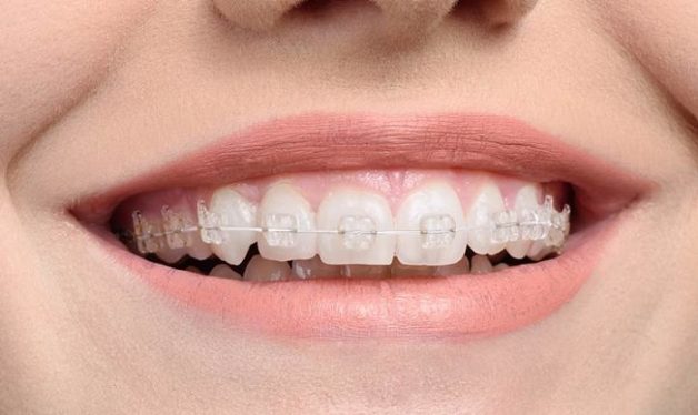 nắn chỉnh răng bằng mắc cài sứ