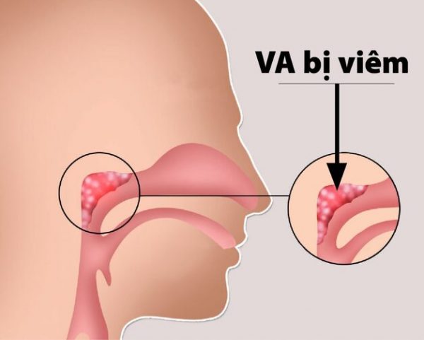 nạo va cho trẻ có đau không