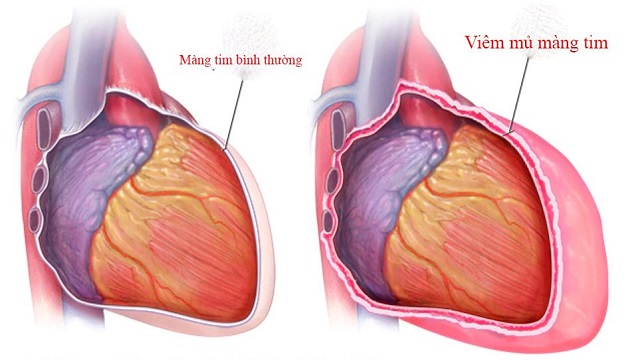 Viêm màng tim là một trong những nguyên nhân gây suy nút xoang tim
