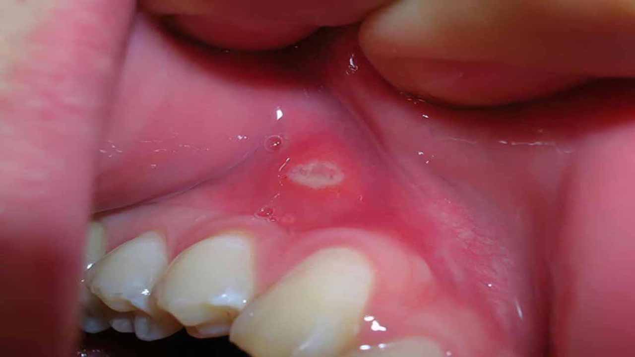 Các cách trị nhiệt miệng ở nướu hiệu quả tại nhà 2 Trị nhiệt miệng ở nướu