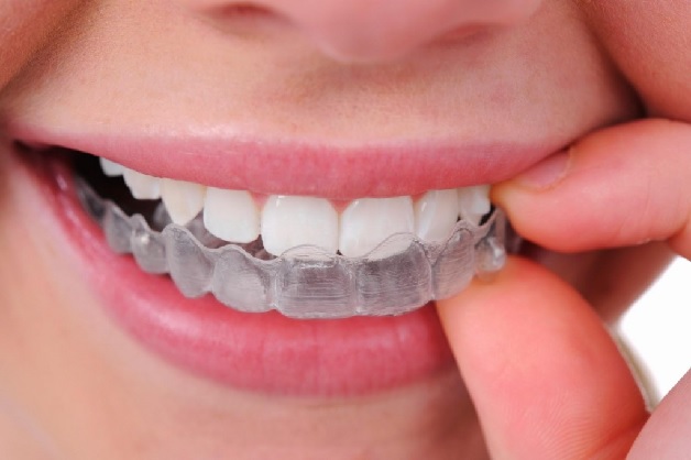 Niềng răng hàm dưới có đau không là thắc mắc của nhiều người