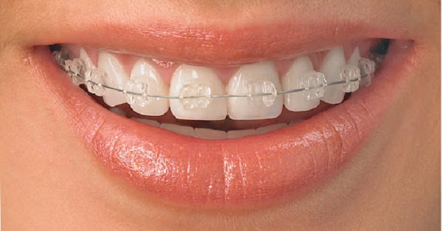 Niềng răng bằng mắc cài pha lê là công nghệ chỉnh nha sử dụng một mắc cài trong suốt, đem lại tính thẩm mỹ cao cho người niềng.