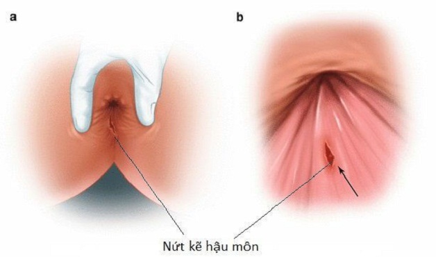 Giải đáp nứt kẽ hậu môn có tự lành không