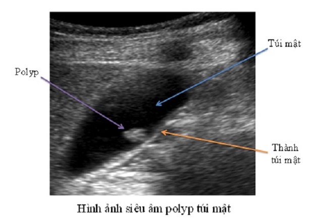 Hình ảnh polyp túi mật trên siêu âm là hình tăng âm và không có bóng cản