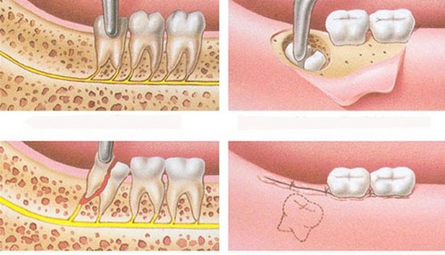 Quy trình nhổ răng khôn mọc ngầm