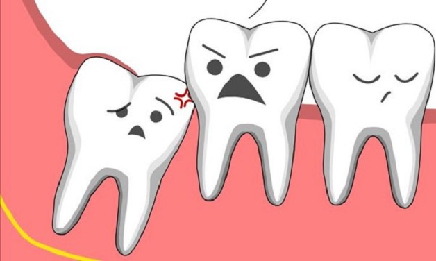Răng khôn là những chiếc răng mọc sau cùng ở trên cùng hàm thường diễn ra vào độ tuổi trưởng thành.