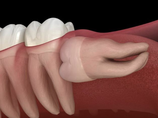 Răng số 8 mọc ngang là khi răng mọc theo góc 90 độ so với răng số 7 và thường gặp ở độ tuổi trưởng thành