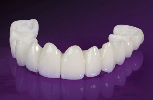 Răng sứ Cercon Đức là loại răng được khách háng sử dụng phổ biến