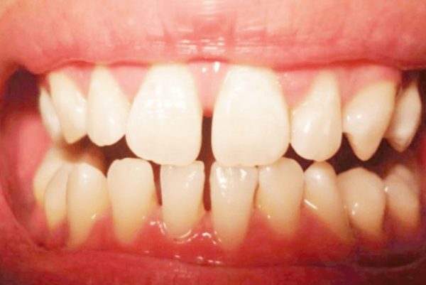 Răng thưa là tình trạng giữa các răng có khoảng cách, tạo nên cảm giác không chắc chắn và khiến thức ăn dễ giắt vào khe.