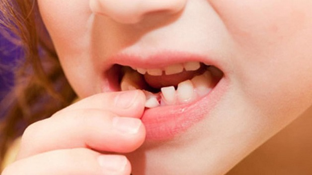 Răng vĩnh viễn của trẻ bị lung lay trong ổ xương hàm thường có thể là do trẻ đang mắc phải các bệnh về răng miệng.