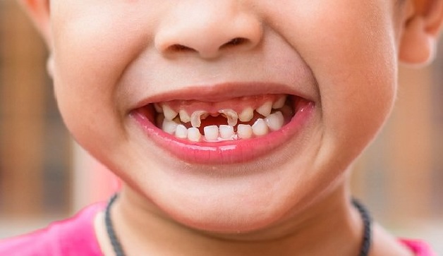 Rất nhiều bé 6 tuổi bị sâu răng
