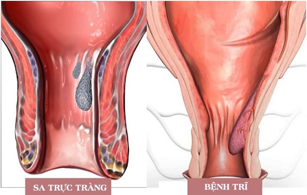 Sa trực tràng và trĩ là 2 bệnh lý khác nhau