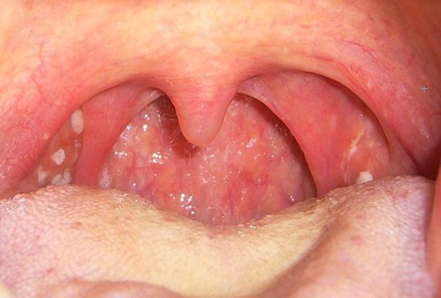 sưng amidan nhưng không đau