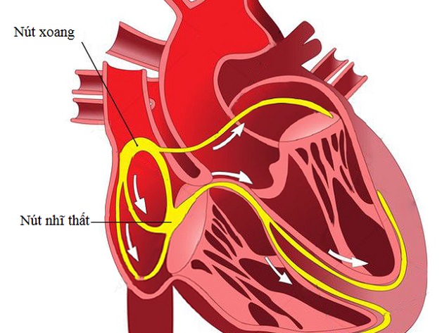 Suy nút xoang là hiện tượng rối loạn chức năng của nút xoang tim