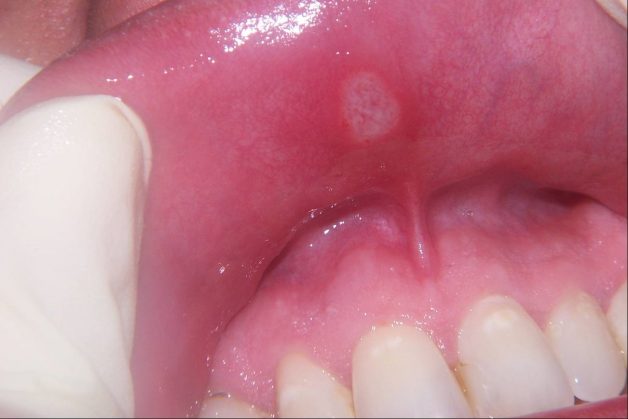 Lý giải vấn đề nhiệt miệng kéo dài