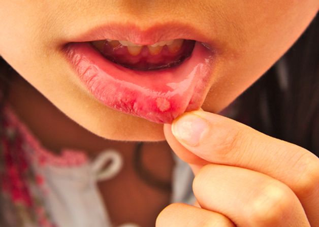 các loại thuốc bôi lở miệng