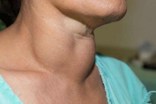 xét nghiệm u tuyến giáp