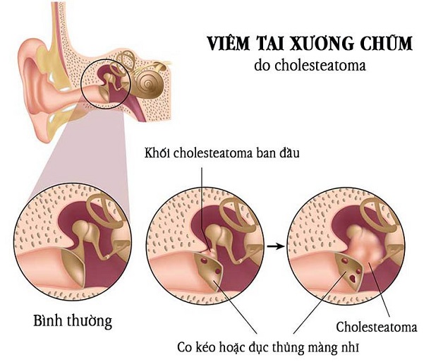 phẫu thuật viêm tai xương chũm