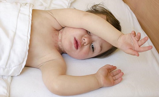 Trẻ bị nổi mẩn đỏ ở cổ