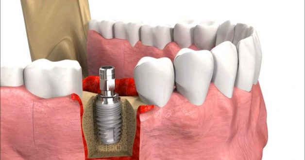 Trụ này được cấy vào phần xương hàm của răng đã mất