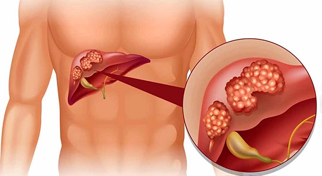 Viêm gan có thể biểu hiện ở nhiều dạng, nhiều giai đoạn bệnh khác nhau