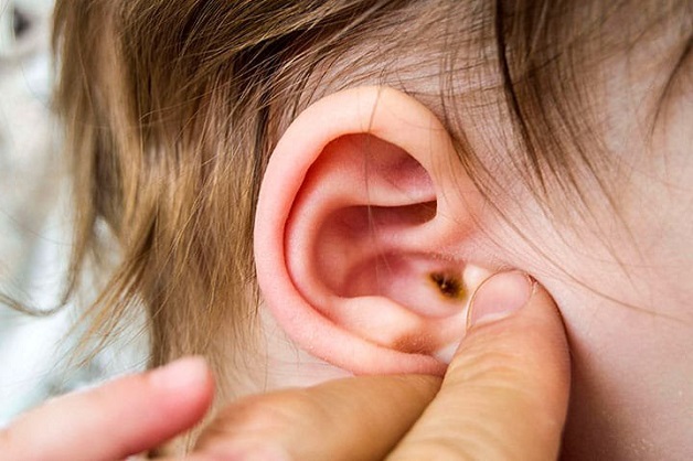 biến chứng viêm tai ngoài ở trẻ