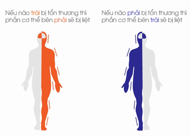 Đột quỵ xuất huyết não gây ra biến chứng gì 