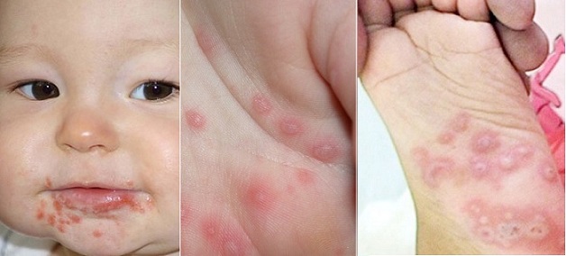 Bệnh tay chân miệng do vi-rút gây ra