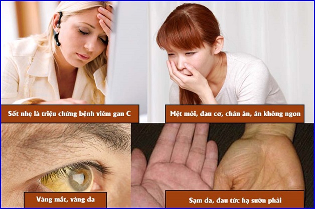 Khi ở giai đoạn mãn tính các triệu chứng viêm gan C ngày càng rõ rệt