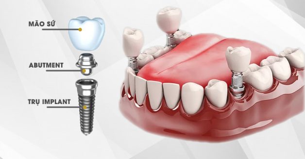 Cấy ghép implant là phương pháp gì