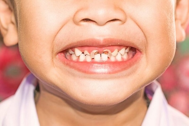 Có nên nhổ răng sâu không? - Sâu răng có thể gặp ở mọi độ tuổi