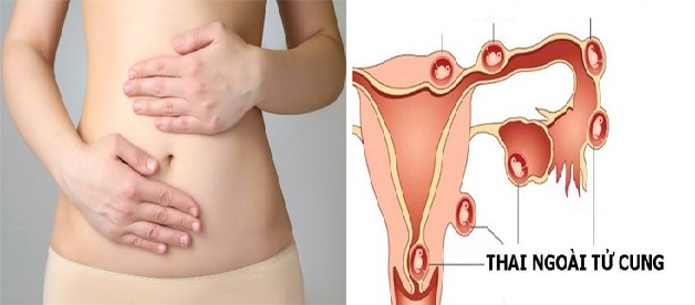 Có thai ngoài tử cung là gì là thắc mắc của nhiều chị em