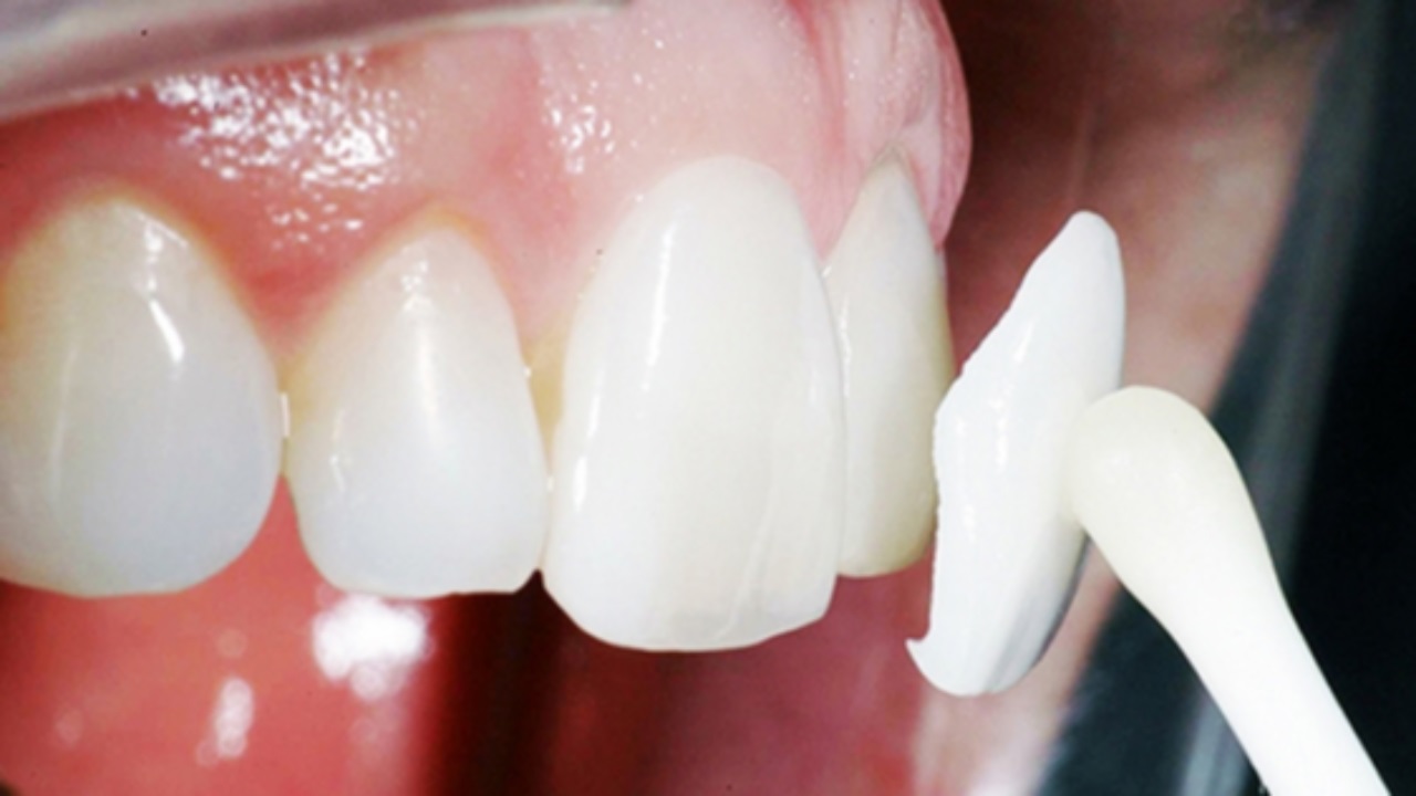 Veneer sứ