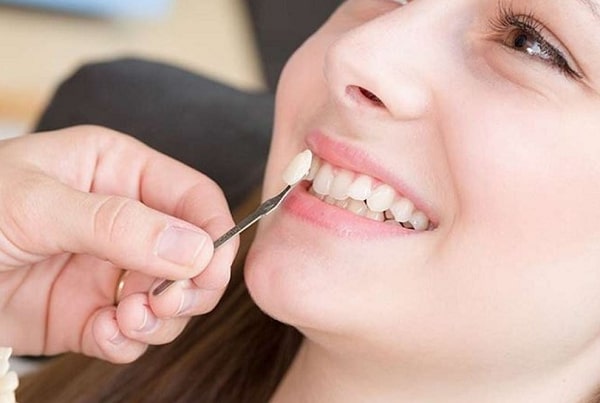 Đắp răng khểnh là phương pháp hiệu quả