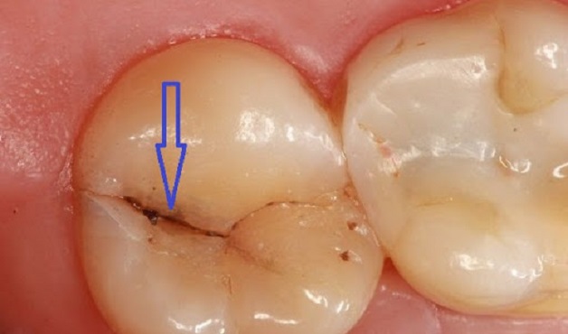 Nứt răng số 7 là một trong những bệnh lý hay gặp với triệu chứng điển hình là cảm giác đau nhức