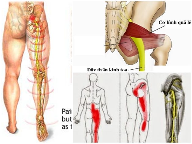 Nguyên nhân gây đau dây thần kinh tọa
