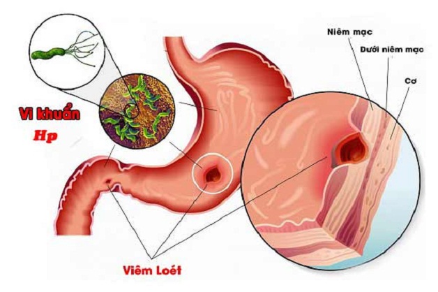 Không phải tất các các trường hợp bệnh đều phải diệt vi khuẩn Hp trong dạ dày
