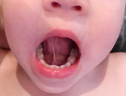 Hình ảnh thắng lưỡi bình thường