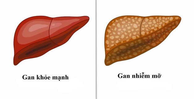 Sự khác nhau giữa gan bình thường và gan nhiễm mỡ