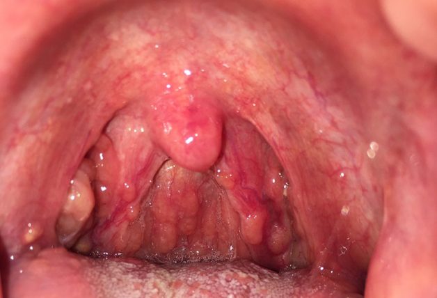 Nguyên nhân gây viêm họng mạn tính 
