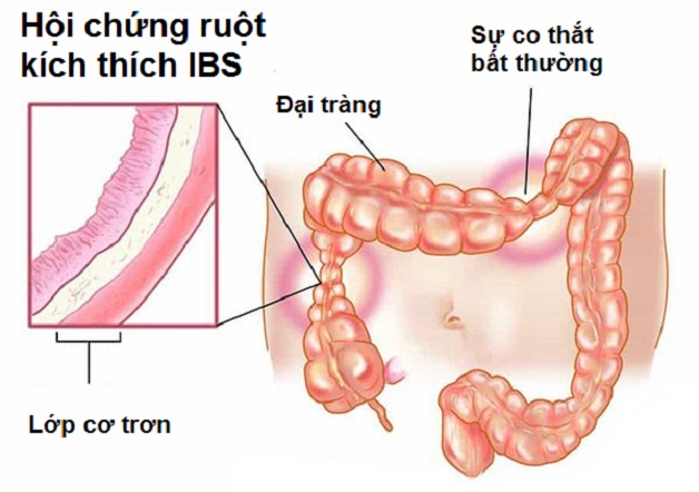 Hội chứng ruột bị kích thích là gì?