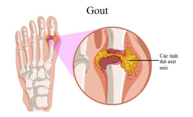Tophi chính là những khối tinh thể urate cứng, ở bên dưới da, hình thành ngay tại các khớp và sụn ở ngón tay, bàn tay, cổ tay, bàn chân, cổ chân, mắt cá chân...