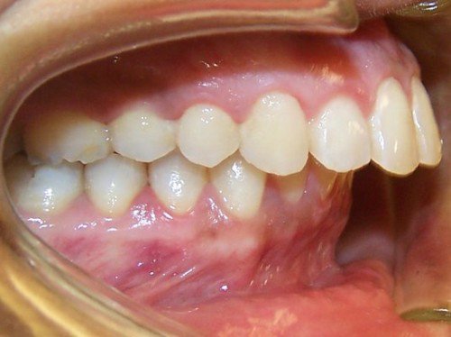 Khớp cắn sâu là tình trạng hàm dưới lọt sâu vào bên trong và khuất sâu ở trong hàm trên