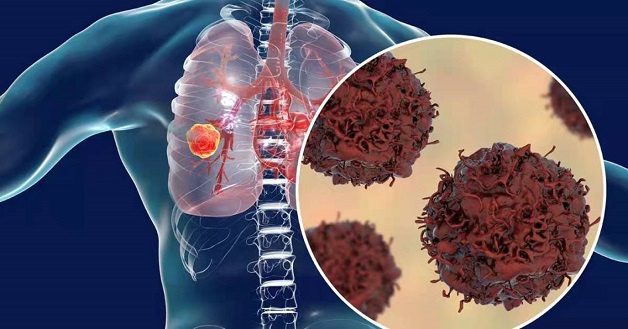 Cách điều trị ung thư phổi tế bào nhỏ