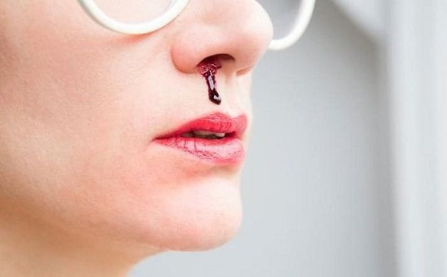triệu chứng lệch vách ngăn mũi